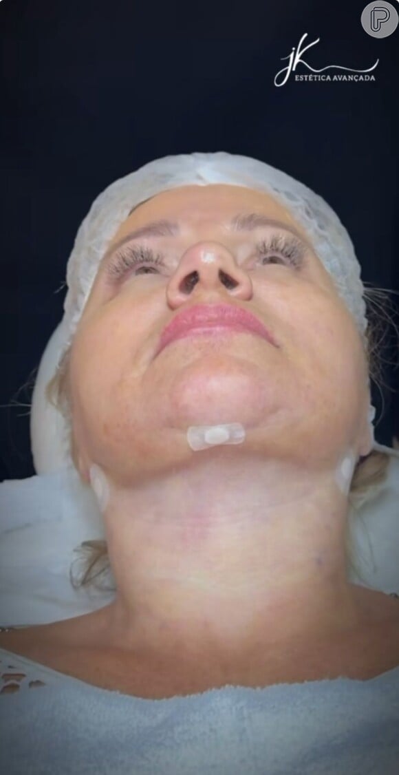 Irmã de Eliana passou por um procedimento de rejuvenescimento facial que mudou muito seus traços