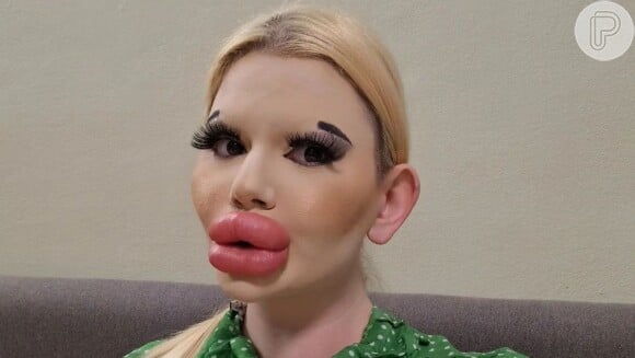 Mulher com os maiores lábios do mundo choca web e recebe alerta de médicos após 43 procedimentos estéticos