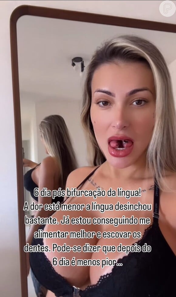 Andressa Urach mostrou a aparência de sua língua uma semana após a bifurcação