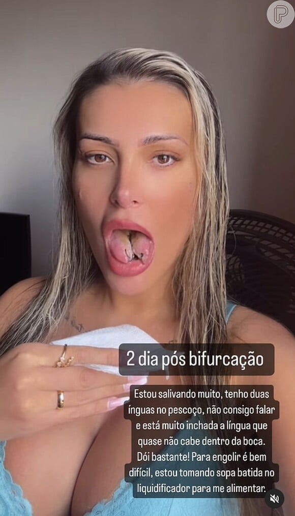 Andressa Urach está de repouso em casa por causa do procedimento doloroso na língua