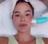 Em seu rosto, Bruna Marquezine utiliza o Ultrassom Microfocado, uma técnica que dá resultado de lifting facial sem aplicações