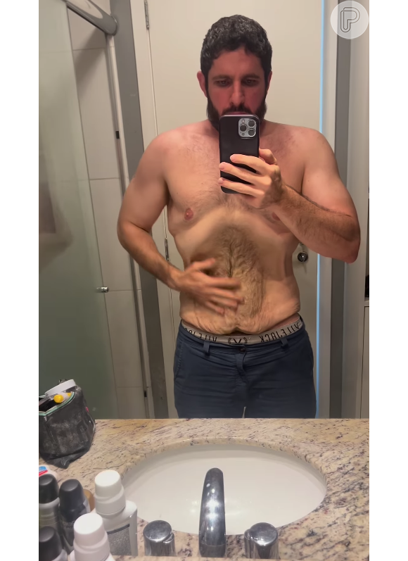 André Serra chegou aos 91 kg só com dieta e exercícios físicos, e agora fará uma abdominoplastia para remover a flacidez em sua pele