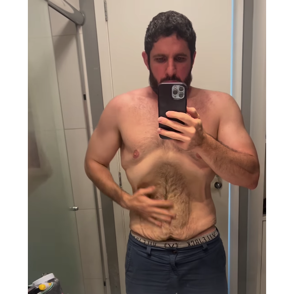 André Serra chegou aos 91 kg só com dieta e exercícios físicos, e agora fará uma abdominoplastia para remover a flacidez em sua pele