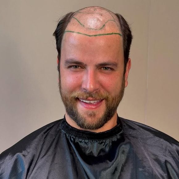 O ex-BBB Gustavo Marsengo passou por um transplante capilar antes de seu casamento com Laís Caldas, que acontecerá no ano que vem