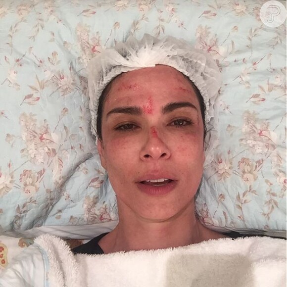 Luciana Gimenez chamou a atenção dos seguidores neste domingo, 02 de agosto de 2015, ao publicar uma foto com sangue no rosto depois de realizar uma sessão de microagulhamento