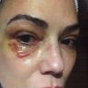 Luiza Brunet acusa Lírio Parisotto de ter lhe quebrado quatro costelas e deixado o seu olho roxo