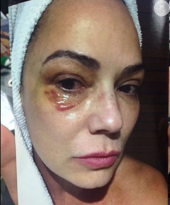 Luiza Brunet acusa Lírio Parisotto de ter lhe quebrado quatro costelas e deixado o seu olho roxo