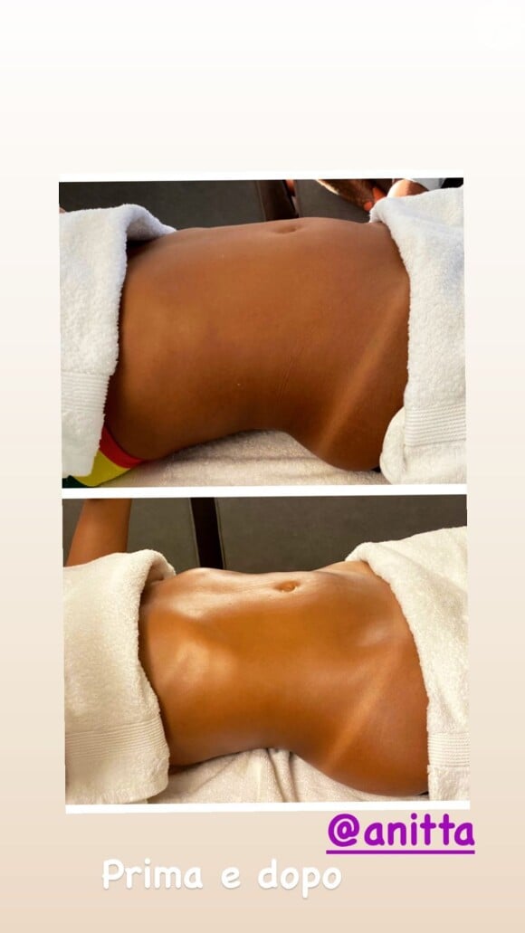 Foto de antes e depois de barriga de Anitta após massagem modeladora