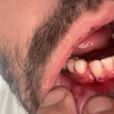 Henri Castelli mostra foto da boca após fratura na mandíbula