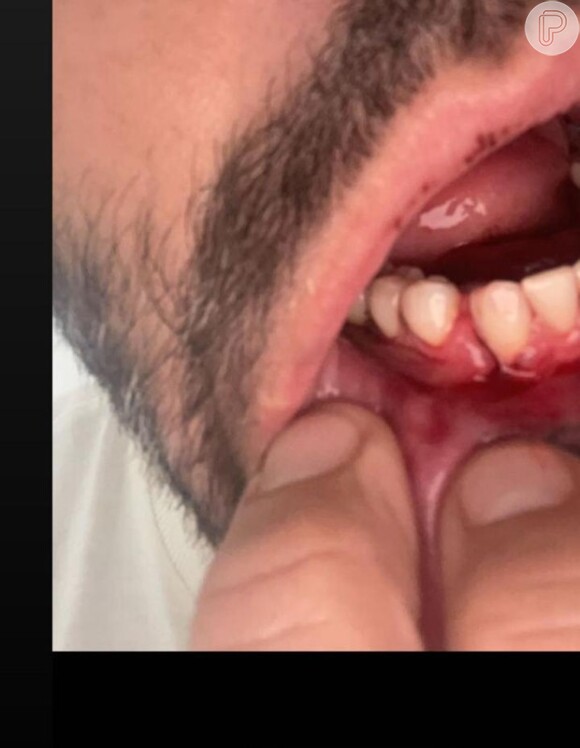 Henri Castelli mostra foto da boca após fratura na mandíbula