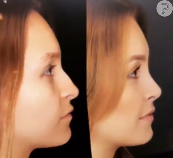 Carla Diaz mostra antes e depois de rinoplastia com Dr. Frederico Keim