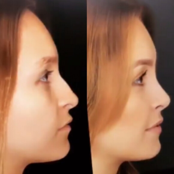 Carla Diaz mostra antes e depois de rinoplastia com Dr. Frederico Keim