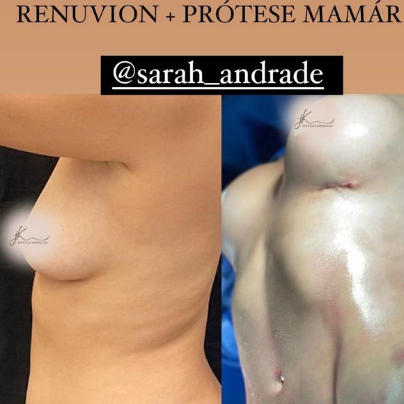 Sarah Andrade faz lipoaspiração e aumenta os seios com próteses de silicone