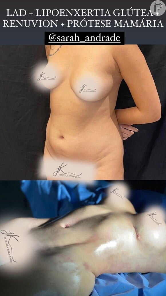 Veja o antes e depois de Sarah Andrade após plásticas