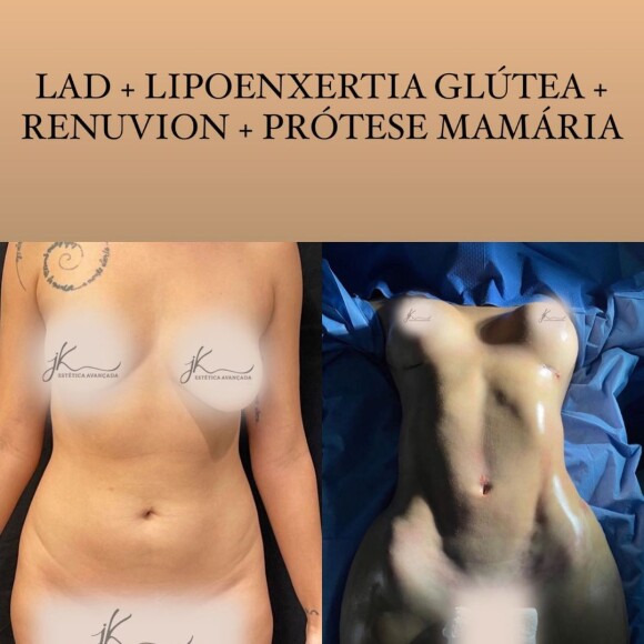 Sarah Andrade se submete a uma lipoaspiração de alta definição, chamada de lipo LAD