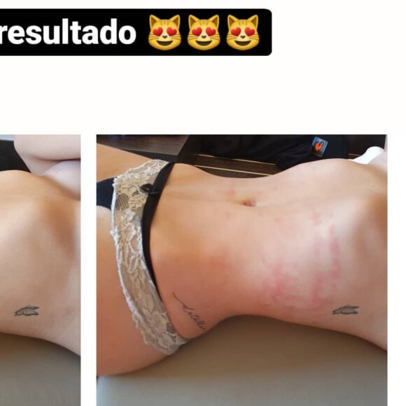 Antes e depois da barriga de Gabi Martins, após procedimento estético