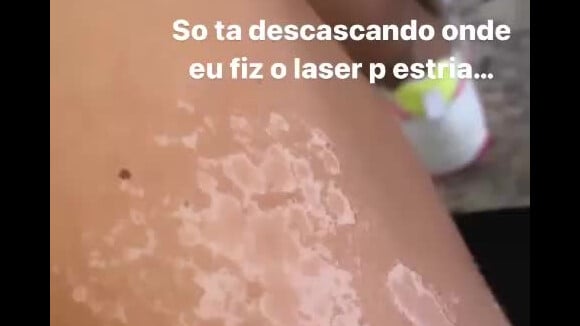 Virgínia Fonseca mostra pele descascando após tratamento de estrias e bronzeamento artificial