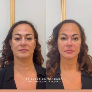 Nadine Gonçalves passou por harmonização facial e aprovou resultado