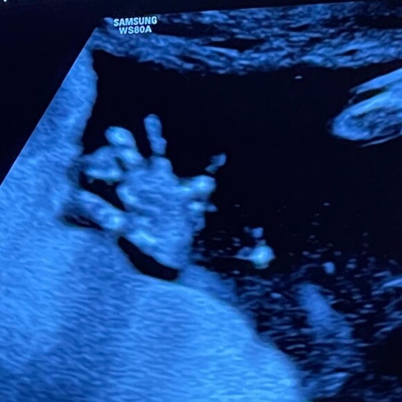 Filho de Whindersson Nunes e Maria Lina, João Miguel nasceu em um parto prematuro