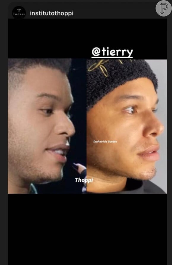 Antes e depois: Tierry fez harmonização facial e realçou seus traços
