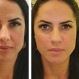 Antes e depois: Graciele Lacerda fez harmonização facial e realçou seus traços