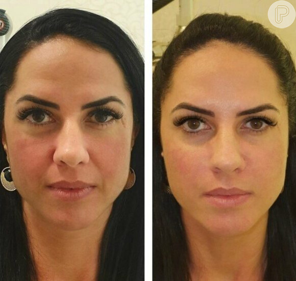 Antes e depois: Graciele Lacerda fez harmonização facial e realçou seus traços