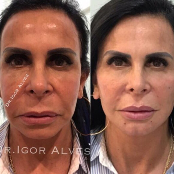 Antes e depois: Gretchen fez harmonização facial e realçou seus traços