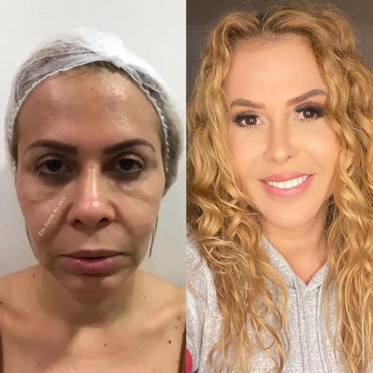 Foto Antes E Depois Joelma Fez Harmoniza O Facial E Real Ou Seus