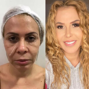 Antes e depois: Joelma fez harmonização facial e realçou seus traços