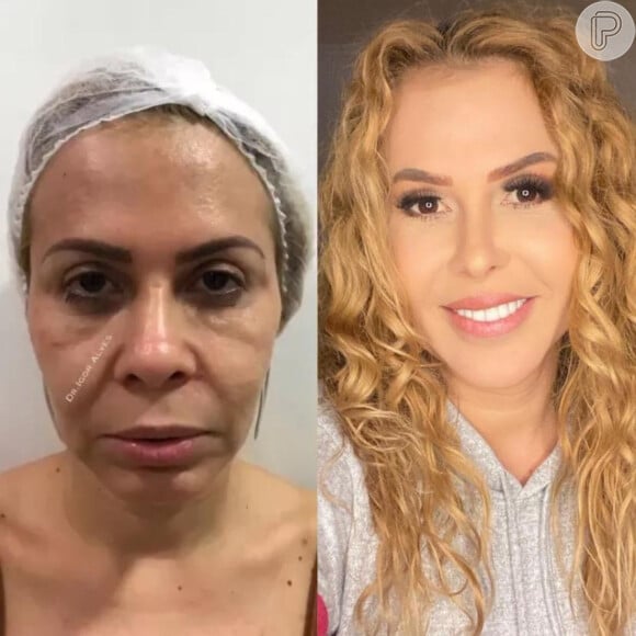 Antes e depois: Joelma fez harmonização facial e realçou seus traços
