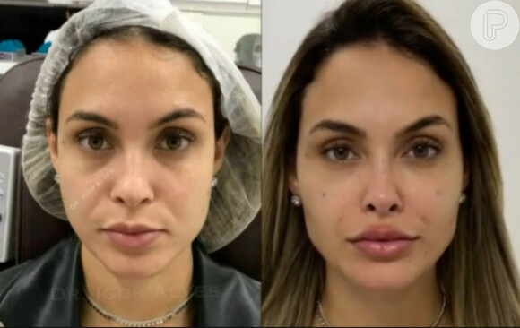 Antes e depois: Sarah Andrade fez harmonização facial e realçou seus traços
