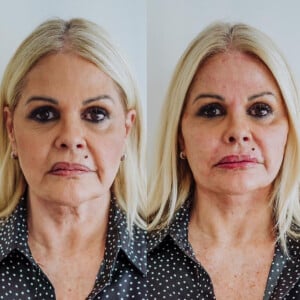 Antes e depois: Monique Evans fez harmonização facial e realçou seus traços