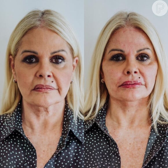 Antes e depois: Monique Evans fez harmonização facial e realçou seus traços