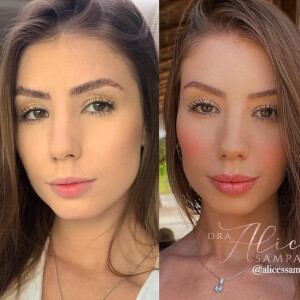 Antes e depois: Maria Lina fez harmonização facial e realçou seus traços