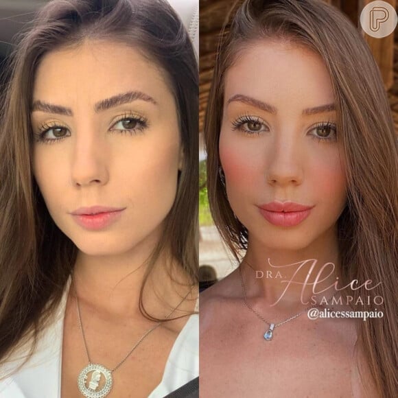Antes e depois: Maria Lina fez harmonização facial e realçou seus traços
