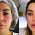 Antes e depois: Naiara Azevedo fez harmonização facial e realçou seus traços