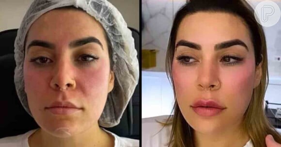 Antes e depois: Naiara Azevedo fez harmonização facial e realçou seus traços