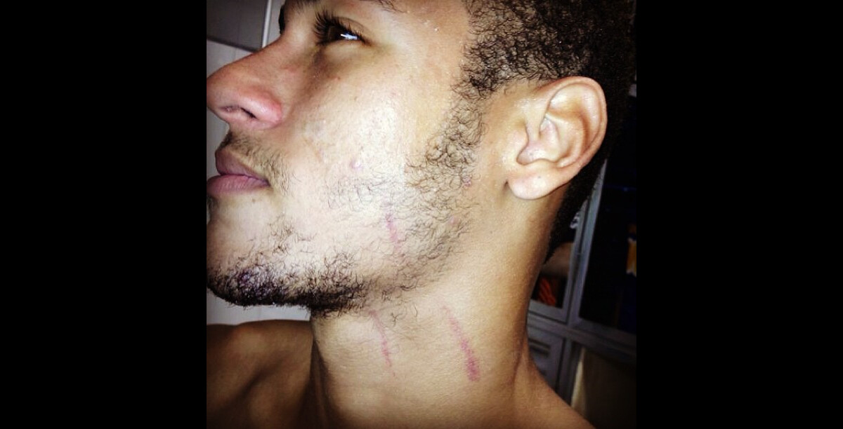 Foto Neymar Publica Foto Do Rosto Arranhado Purepeople foto-neymar-publica-foto-do-rosto-arranhado-purepeople