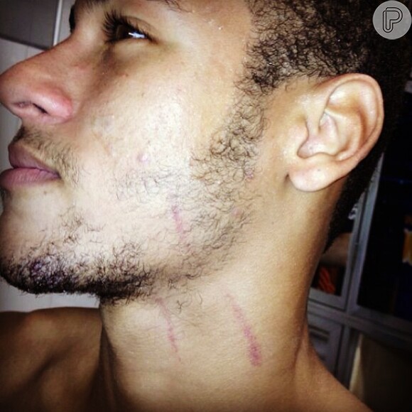 Neymar publica foto do rosto arranhado