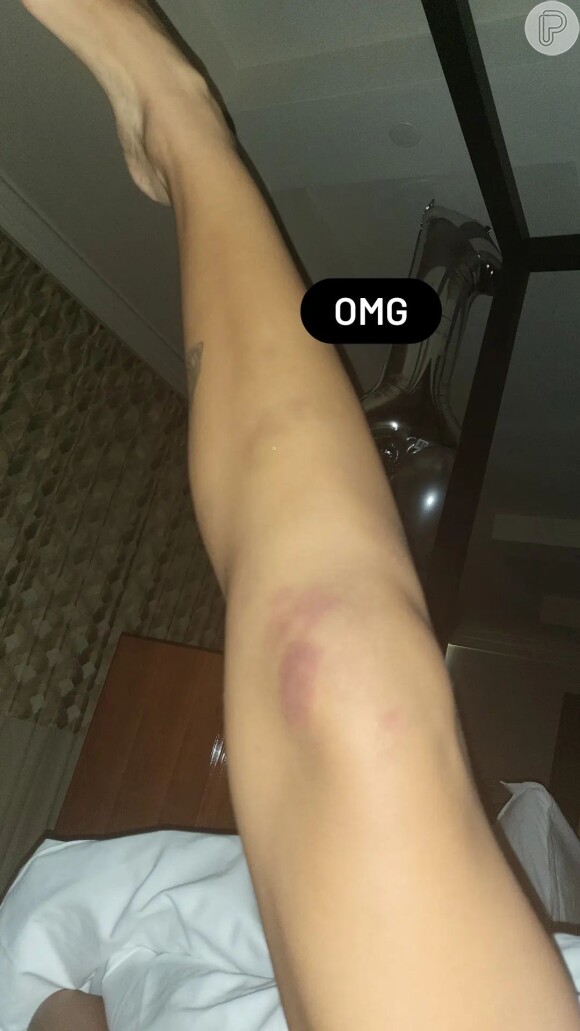 Anitta mostrou hematomas pelo corpo após a festa