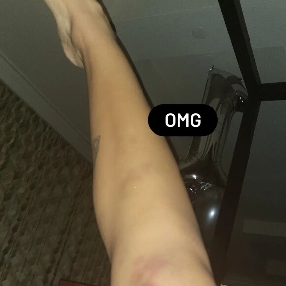 Anitta mostrou hematomas pelo corpo após a festa