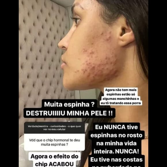 Flayslane mostrou foto das espinhas após a implantação do chip da beleza: 'Destruiu a minha pele'