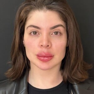 GKay fez preenchimentos em alguns pontos do rosto e aplicação de Botox