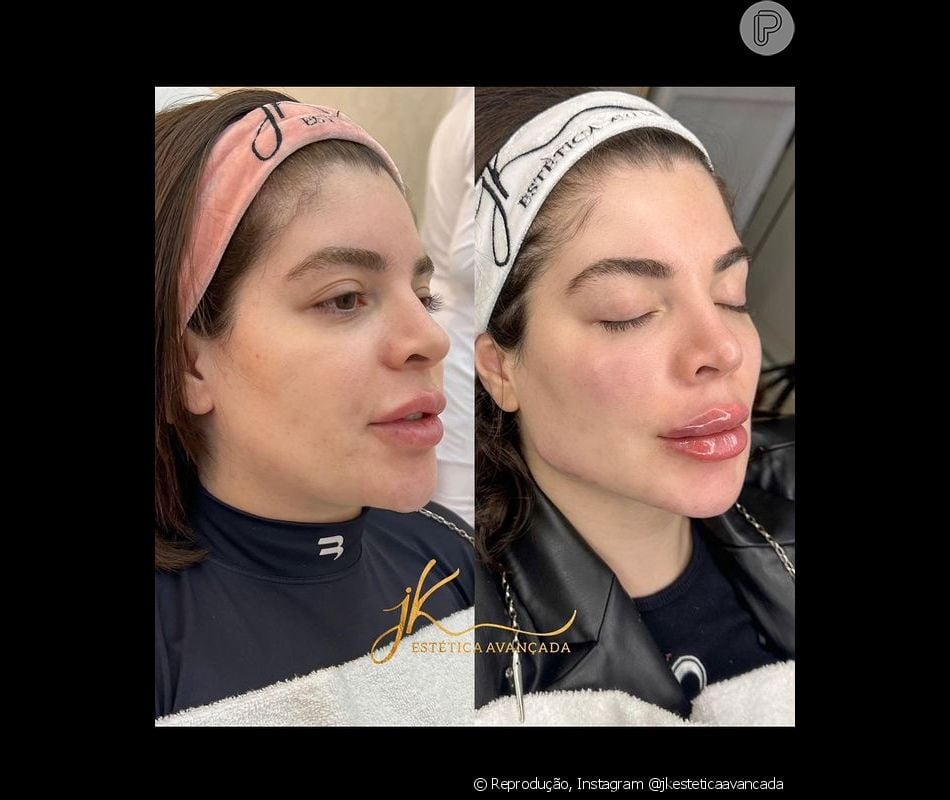 Harmonização facial de Gkay tem antes e depois surpreendente!: fotos