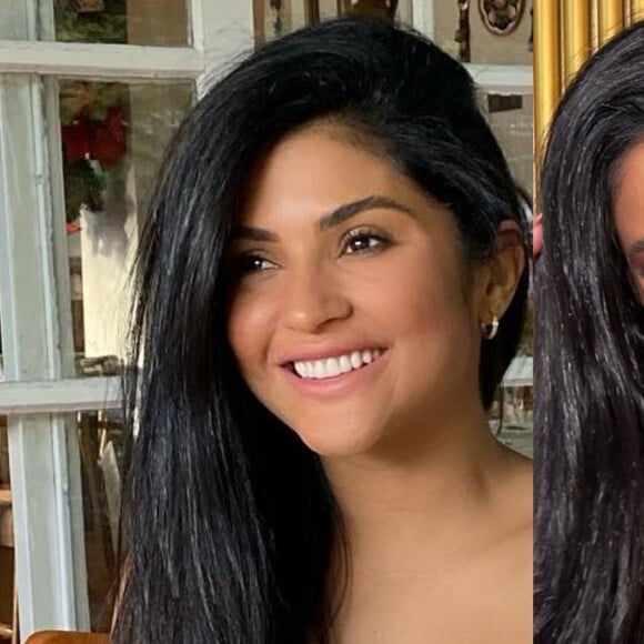 Antes e depois do rosto de Mileide Mihaile mostra resultado de harmonização facial