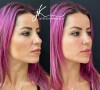 Letícia Bufoni: veja o antes e depois da harmonização facial da skatista