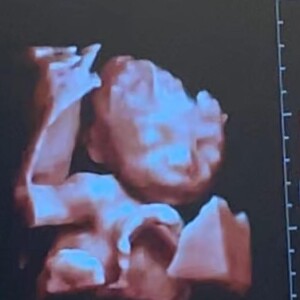 Filha de Cintia Dicker e Pedro Scooby, Aurora foi diagnosticada com doença rara durante exame morfológico