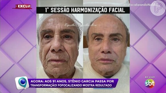 Harmonização facial de Stenio Garcia: ator realizou uma série de procedimentos no rosto