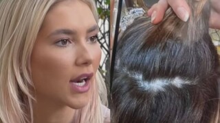 Perdeu até cabelo! Polêmica sobre base fez Virgínia Fonseca desenvolver doença: 'Buraco na cabeça'