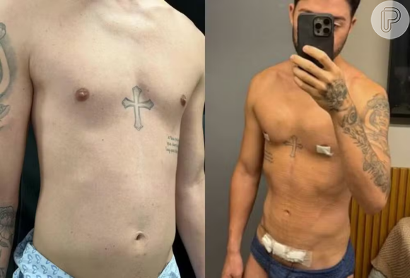 Rico Melquiades faz foto do antes e depois 8 dias após lipoaspiração